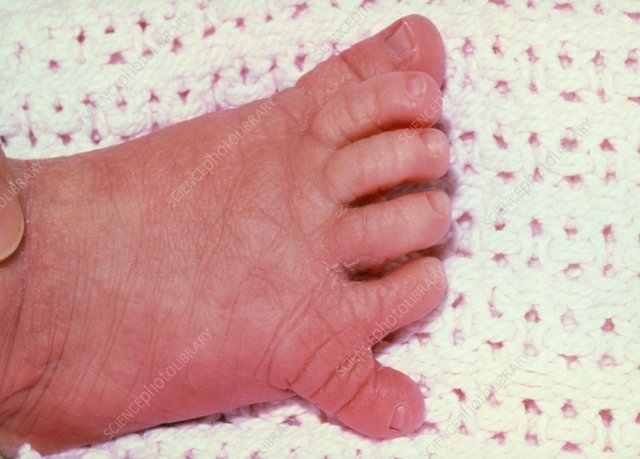 M3500039-Infant-with-six-toes-supernumary.jpg